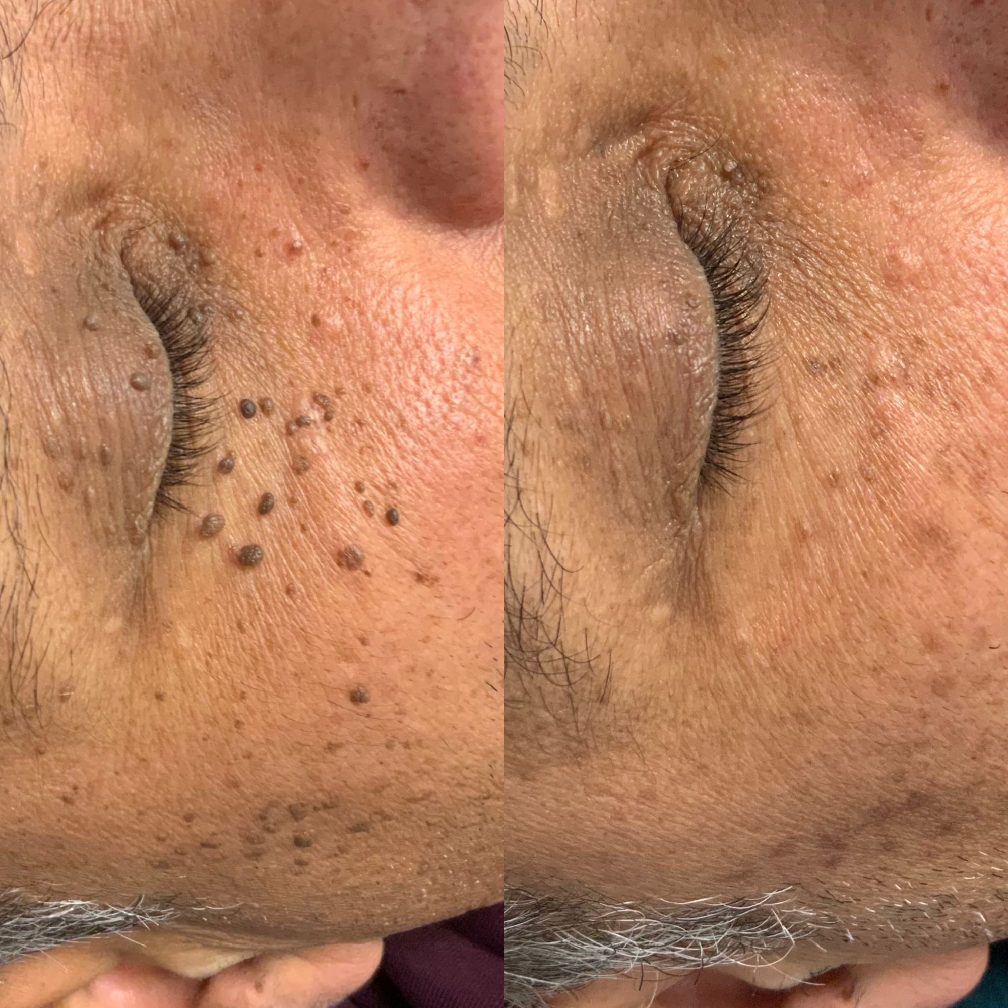 Dermatosis papulosis nigra DPN Huidbureau